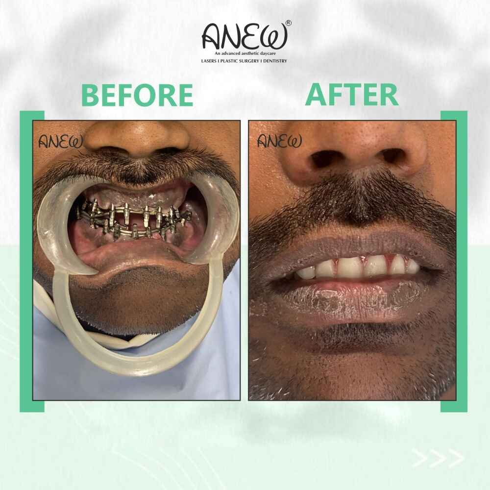 NT Patil Before and After image